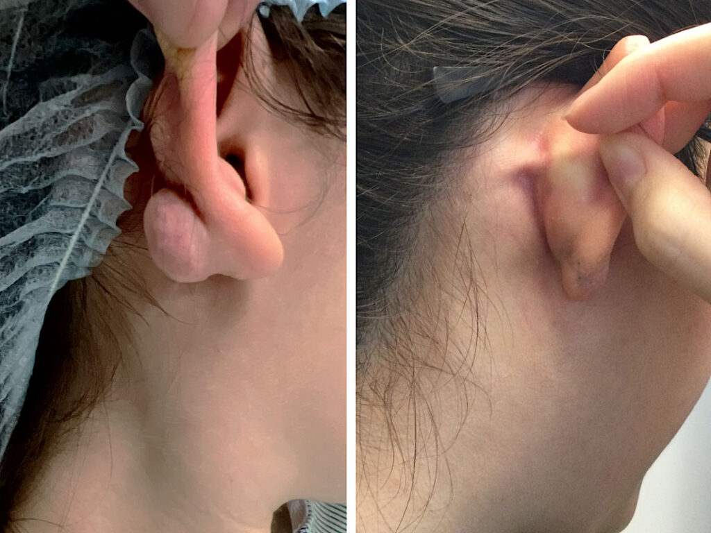 see ear keloid removal