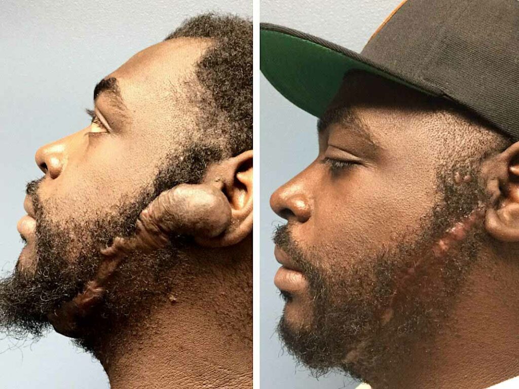 scar removal