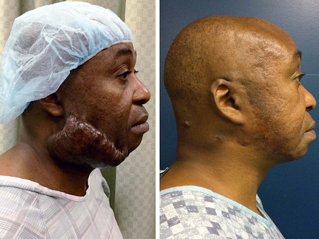facial-keloid-removal-before-after-05.jpg